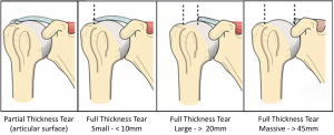 Fig 10. Full Thickness Tears