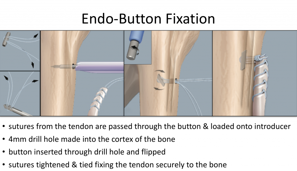 Shoulder Button Surgery Fig 13. Biceps Button - Cambridge Shoulder