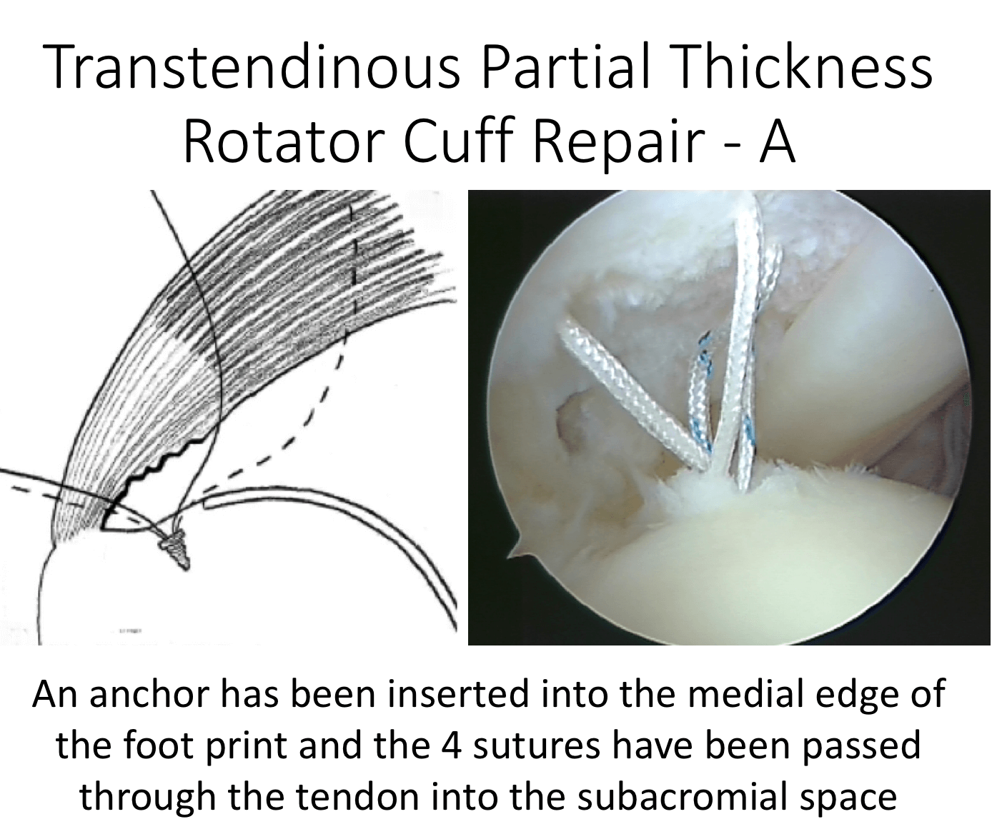 Fig 13. Partial Thickness Repair B