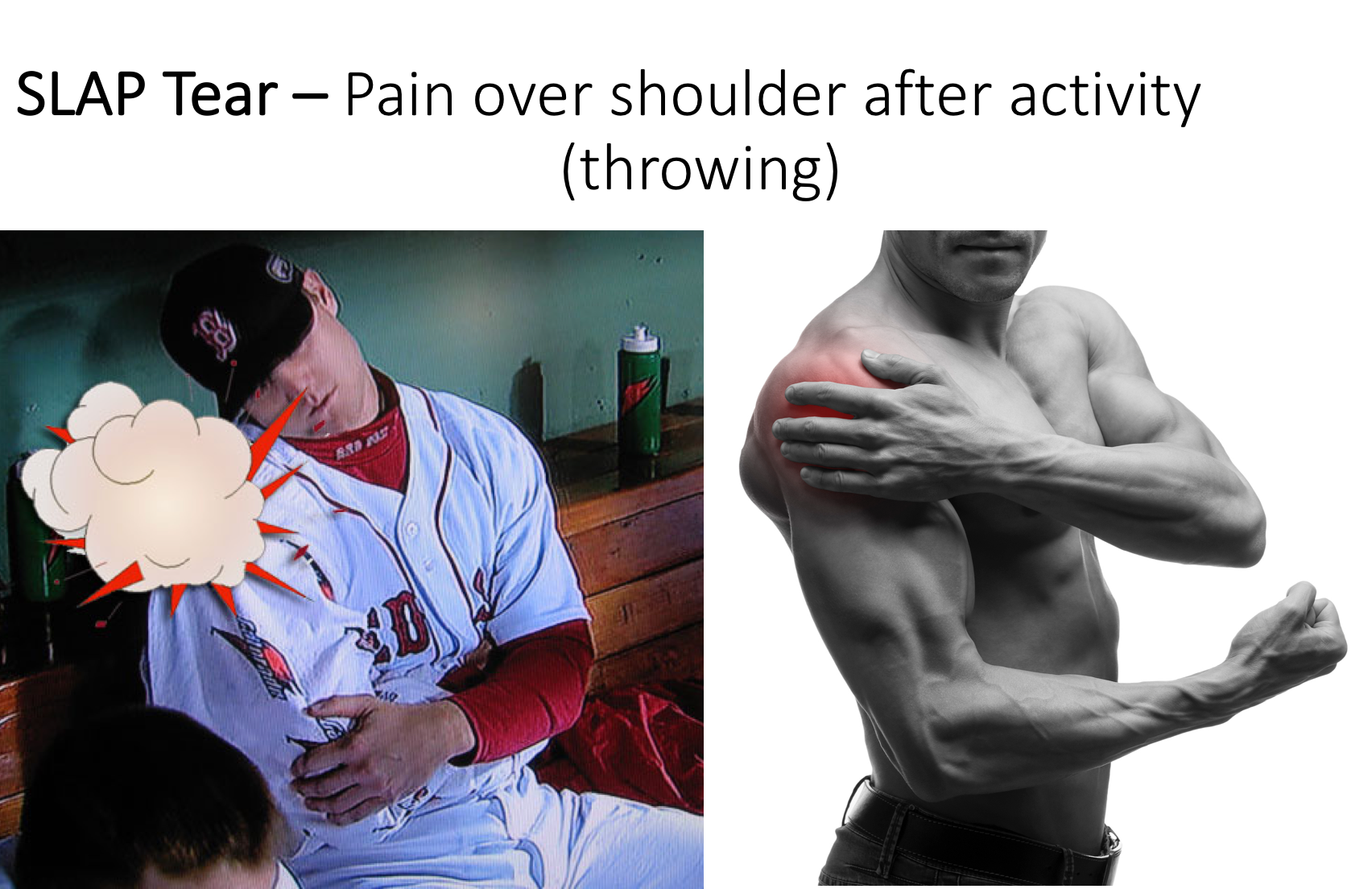 Fig 13. Shoulder Pain