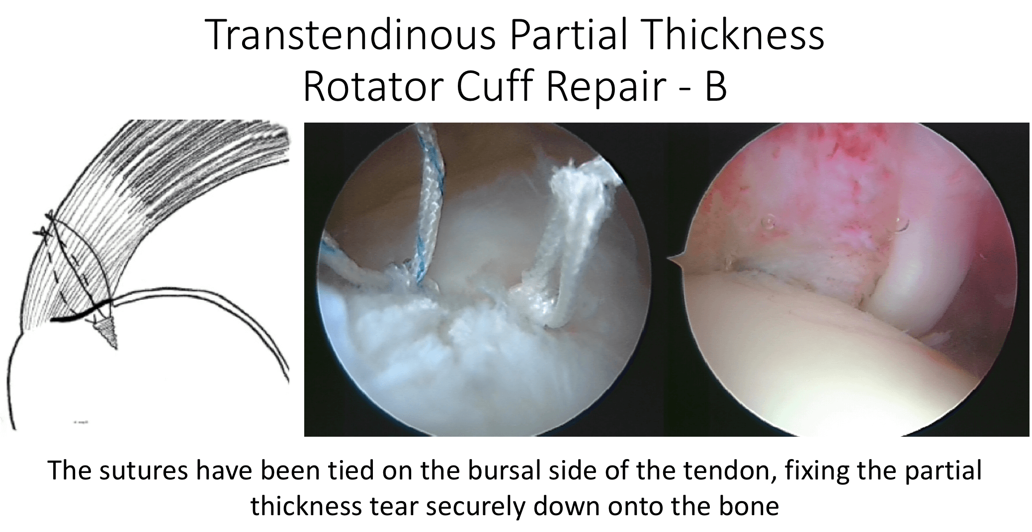 Fig 14. Partial Thickness Repair B