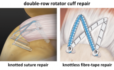 Fig 16. Double-Row Rotator Cuff Repairs - Cambridge Shoulder