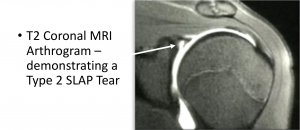 Fig 16. SLAP MRI