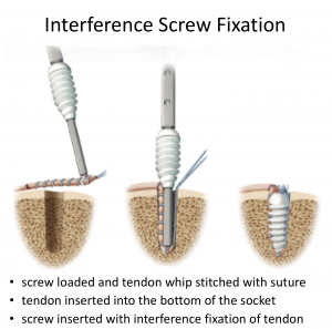 Fig 17. Interference Screw Fixation