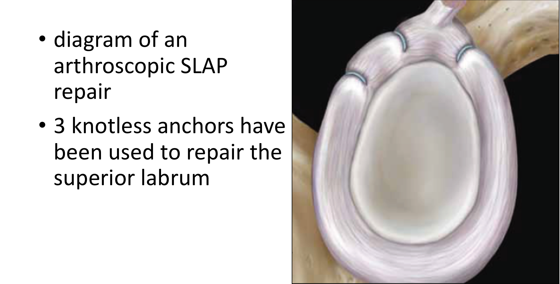 Fig 18. Arthro SLAP repair