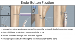 Fig 18. Endo-Button Fixation