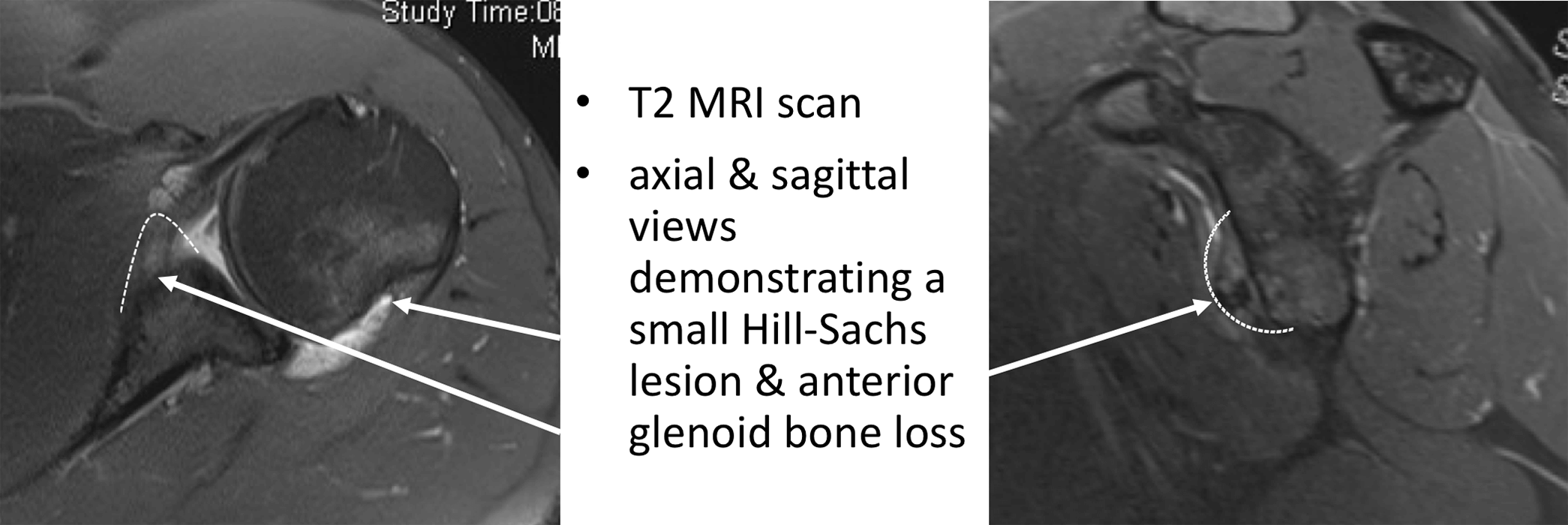 Fig 28. MRI Glenoid Bone Loss