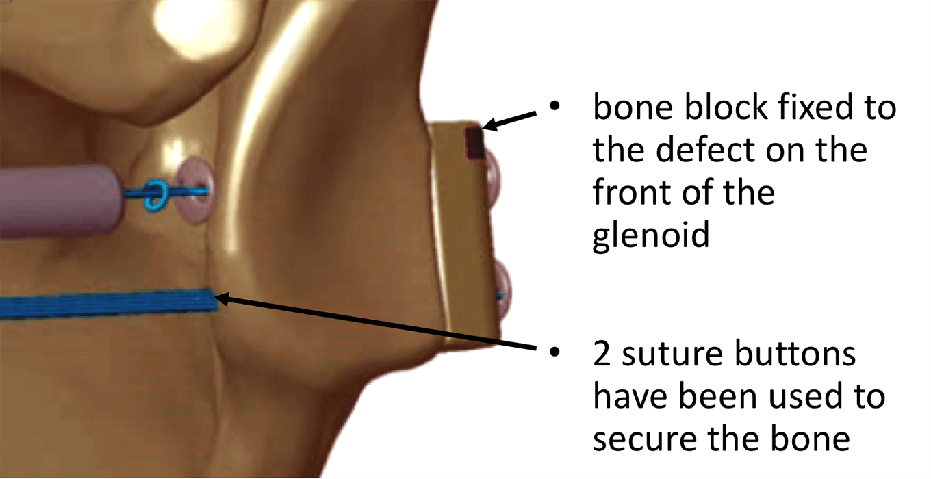 Fig 37. Eden-Hybinette suture button