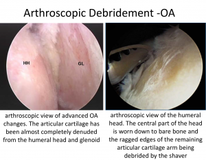 Fig 4. Arthroscopioc view of a shoulder with severe OA and rescetion