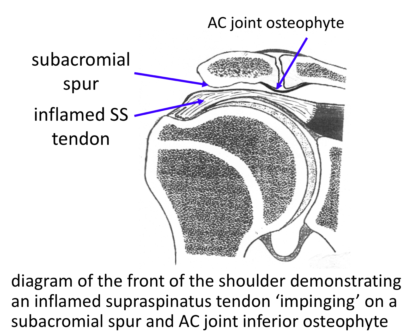 Fig 4. Spur & ACjt osteophyte