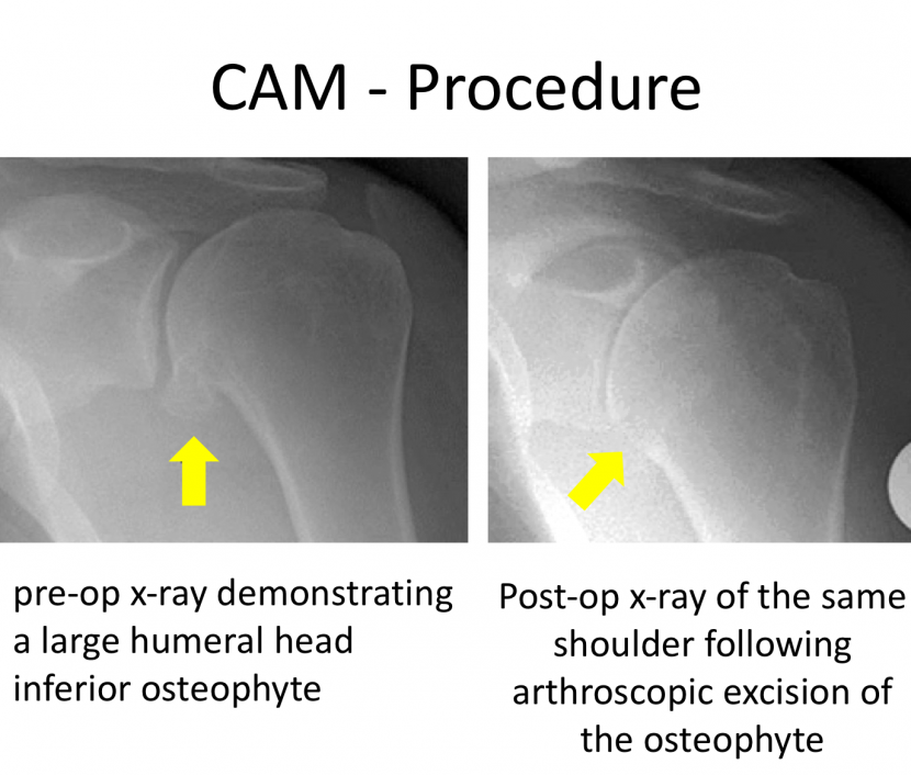Fig 5. CAM Procedure_ Osteophyte resection Cambridge Shoulder