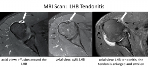 Fig 6. MRI Tendonitis