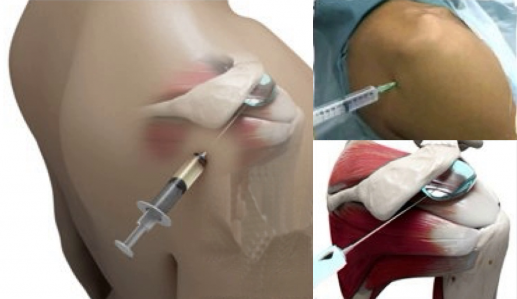 Fig 7a Subacromial Injection Cambridge Shoulder