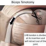 Fig 8. Biceps Tenotomy