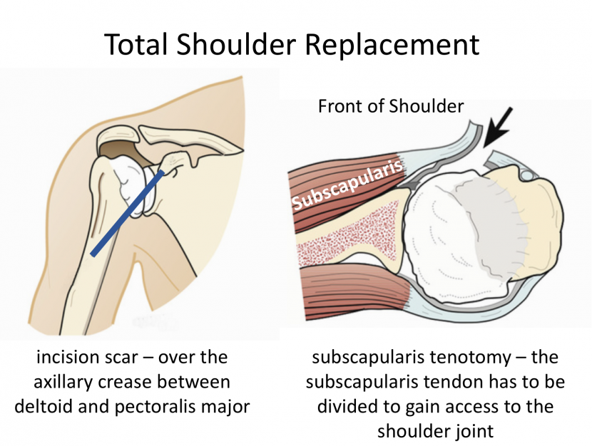 Shoulder Incision Names Fig 9. Incision – Cambridge Shoulder