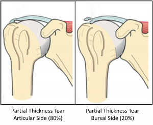 Fig 9. Partial Thickness Tear