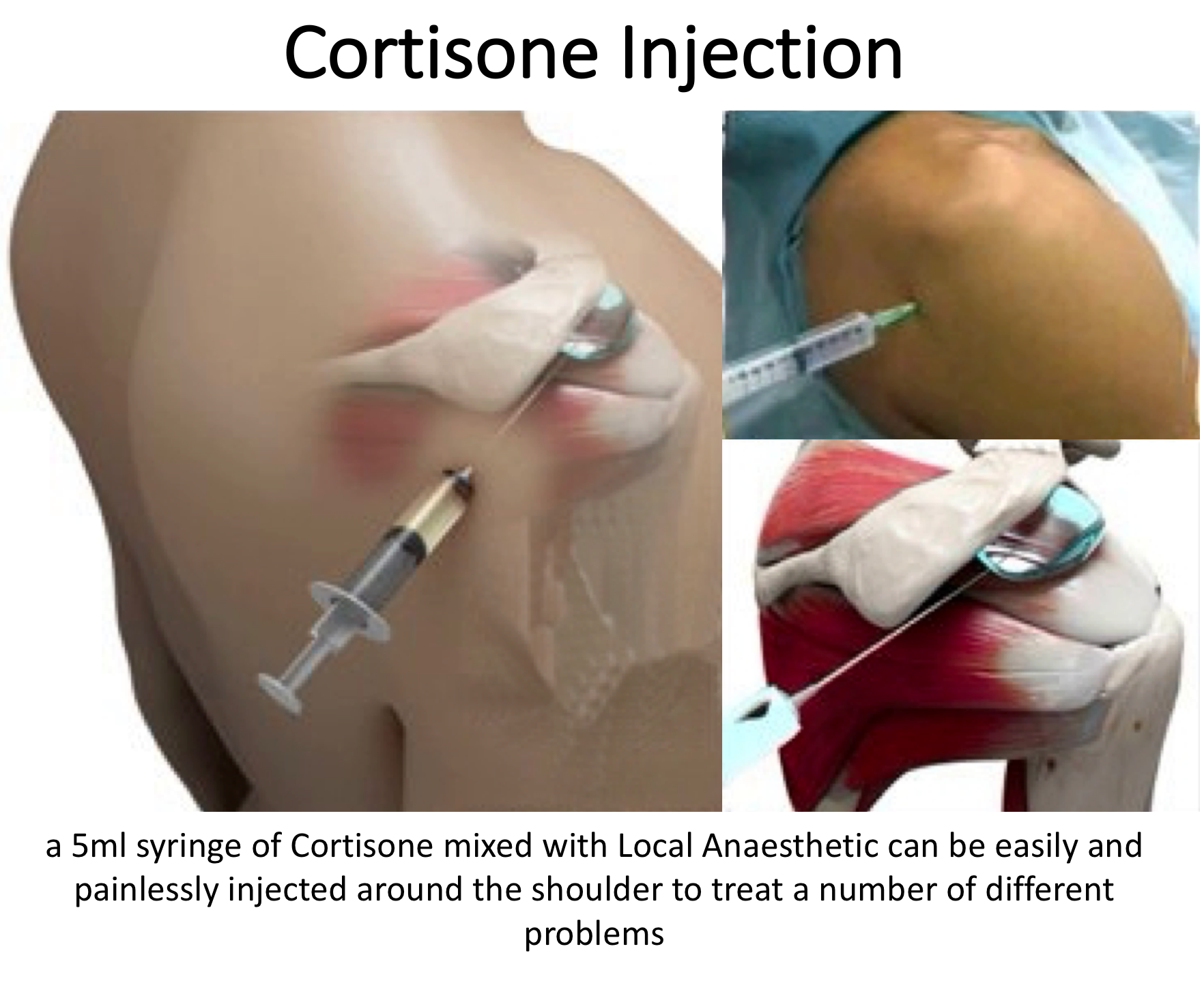 Fig C. Cortisone Injection