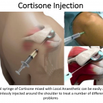 Fig C. Cortisone Injection