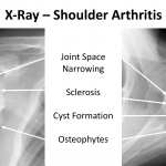 Fig 2. X-Ray of Shoulder OA