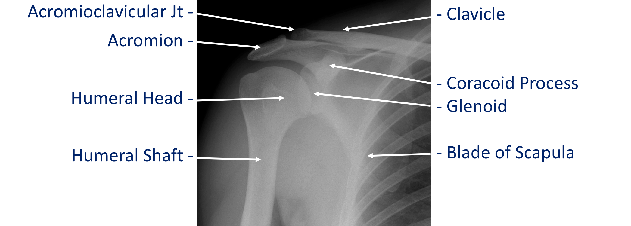 X Ray Shoulder Anatomy SHOULDER JOINT X RAY PART 2 CONTROVERSY X Ray Shoulder Anatomy SHOULDER JOINT X RAY PART 2 CONTROVERSY