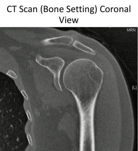 Fig 11. CT Coronal