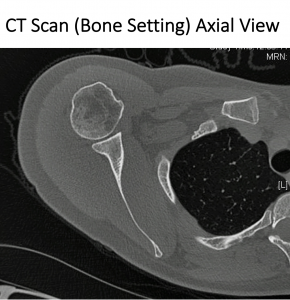 Fig 12. CT Axial