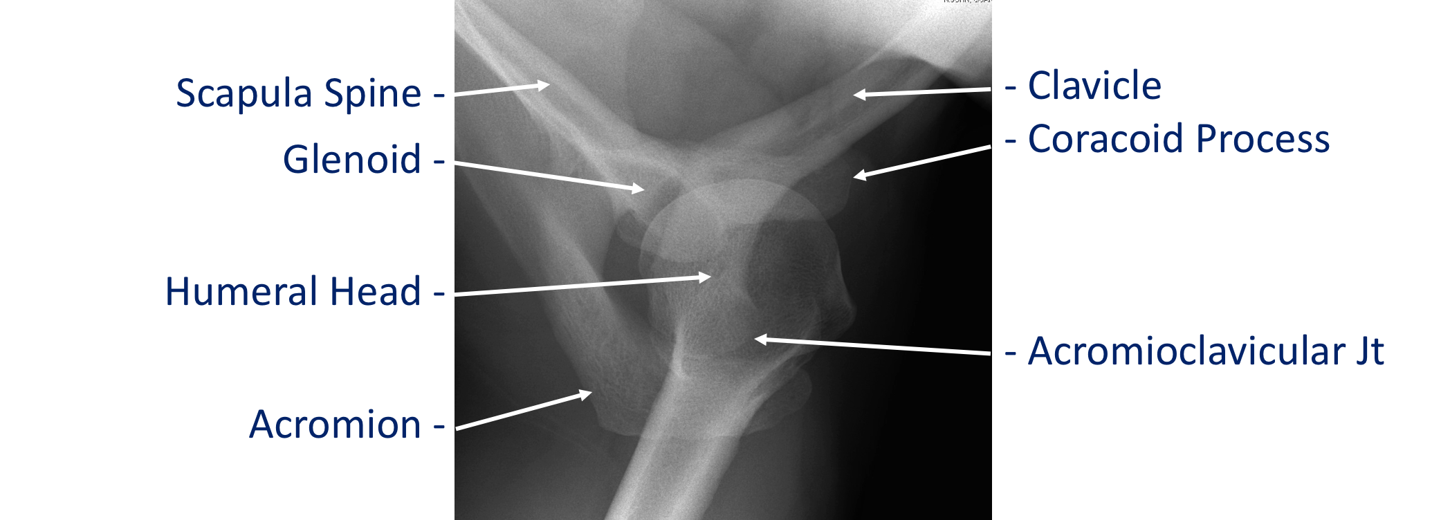 Fig 2. X-Ray Axillary