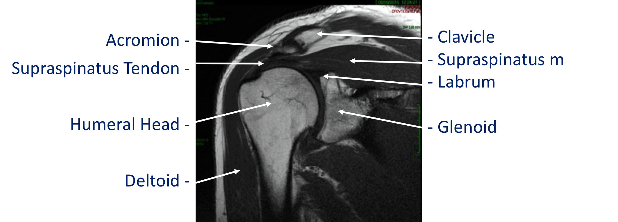 Fig 6. MRI T1 Coronal