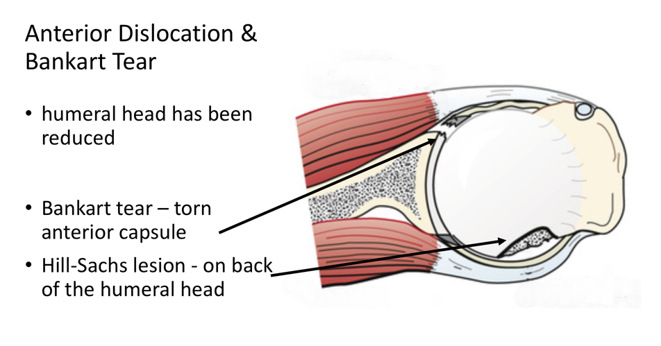 fig_8_traumatic_anterior_dislocation_-_the_head_has_been_reduced_leaving_a_bankart_tear_and_hill-sachs_lesion