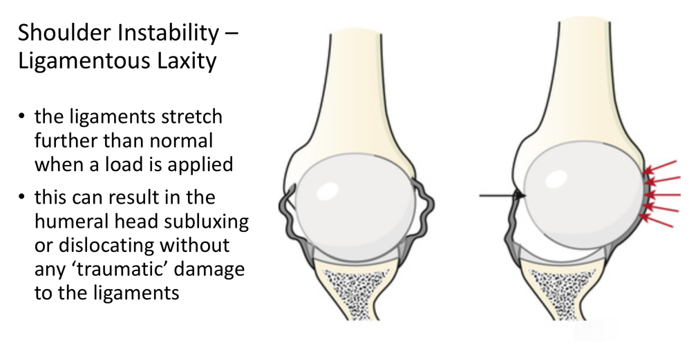 fig_9_ligamentous_laxity_instability_-_lax_capsular_ligaments_allow_the_head_to_dislocate_with_no_traumatic_injury